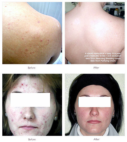 izotrex anti aging