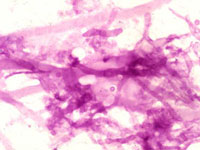 PAS stain of aspergillus seen in a skin biopsy