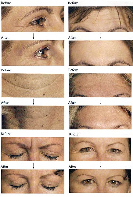 botox