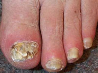 Onychomycosis