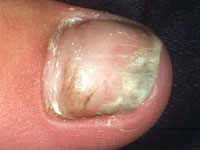 Onychomycosis