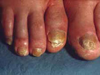 Onychomycosis