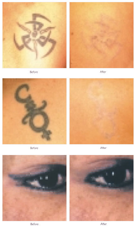 Tattoo Removal, Laser Tattoo Removal & Treatment