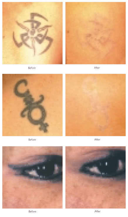 Tattoo Removal, Laser Tattoo Removal &amp; Treatment