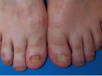 Onychomycosis